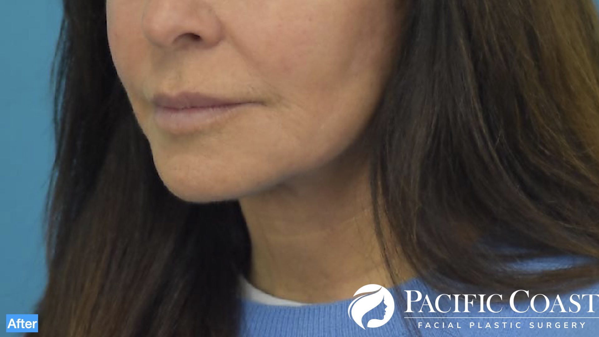 best facelift surgeon in orange county