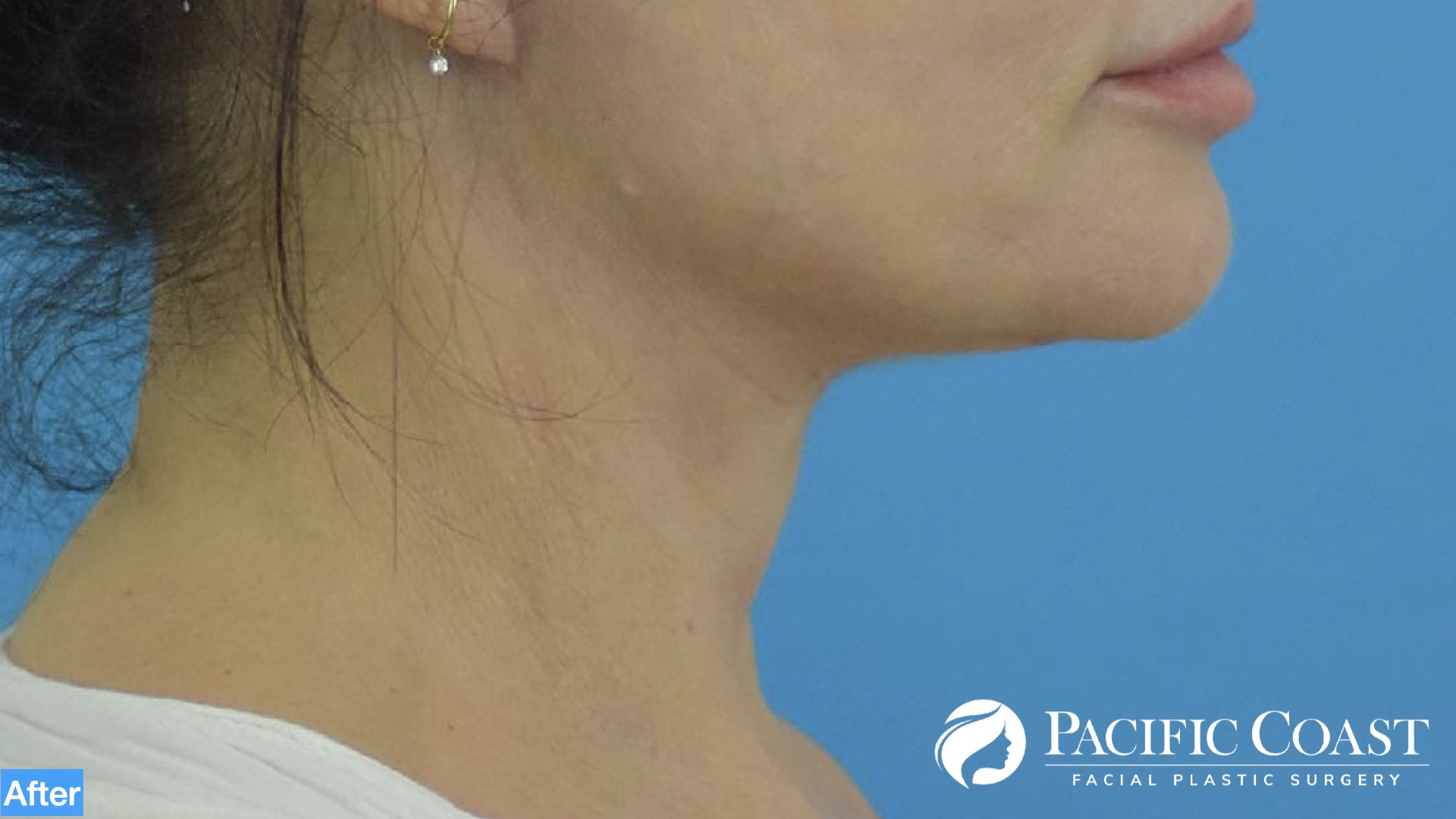 best necklift surgeon orange county