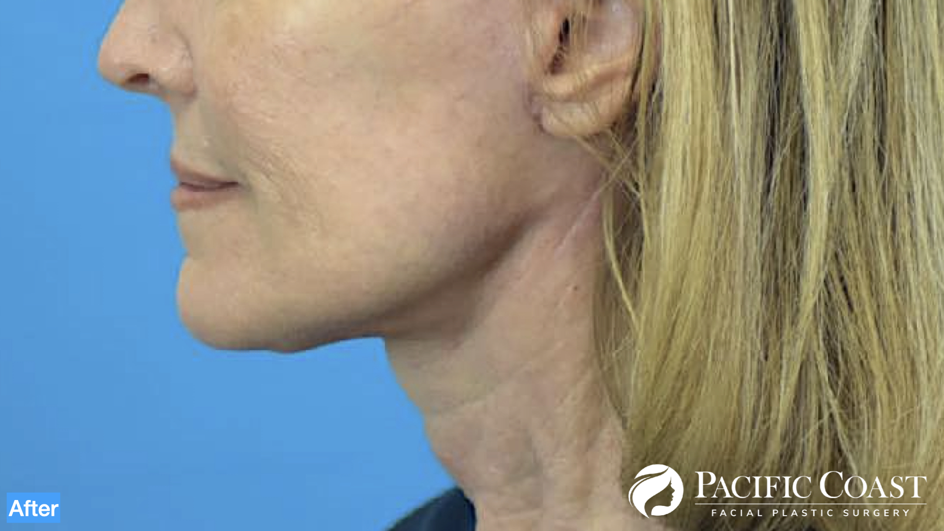 deep plane neck lift orange county