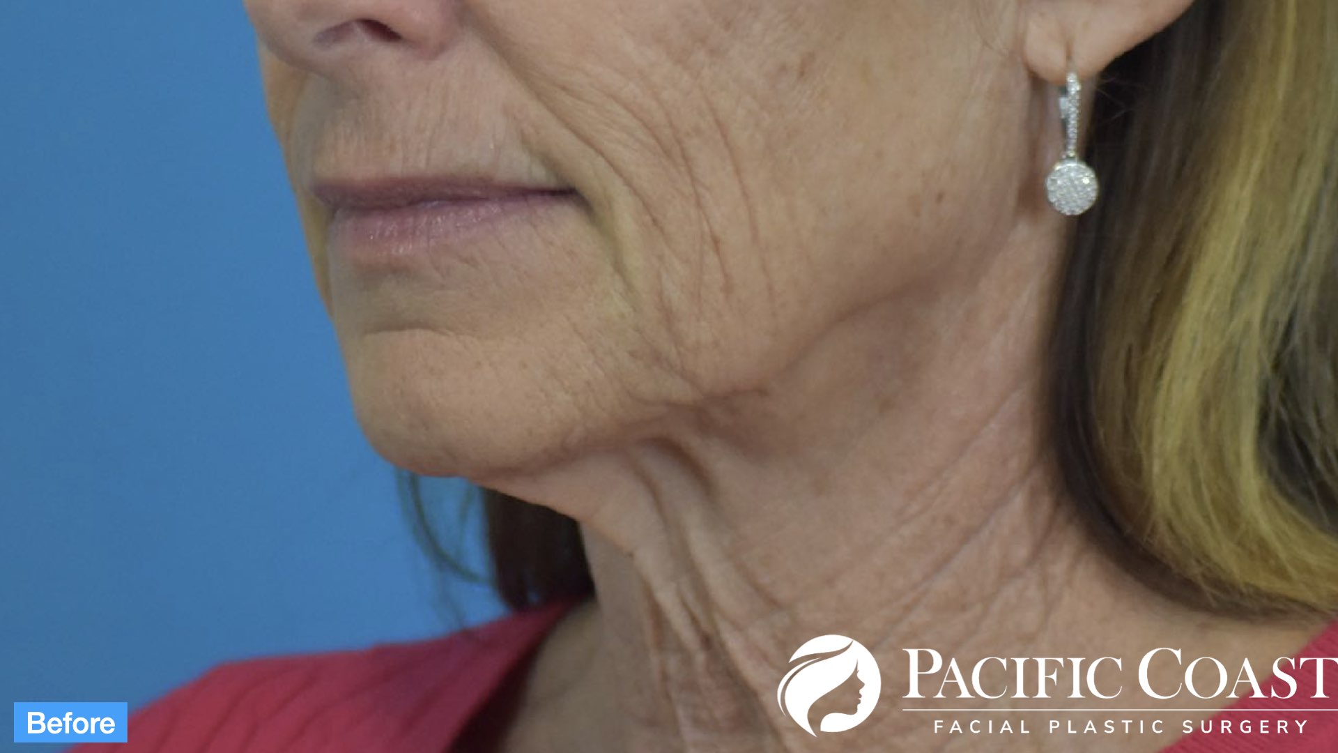 best facelift surgeon in california