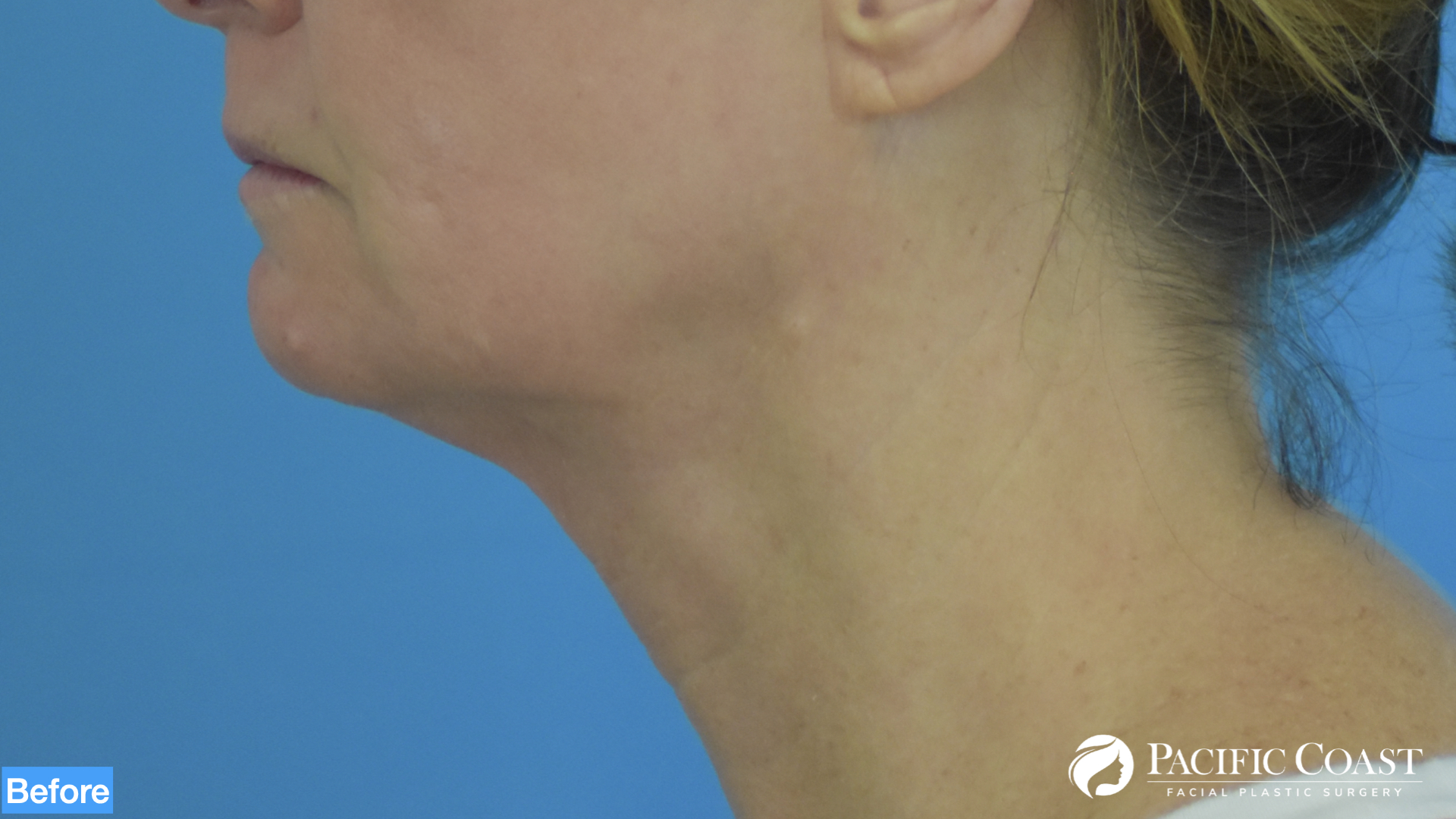 neck lift laguna beach