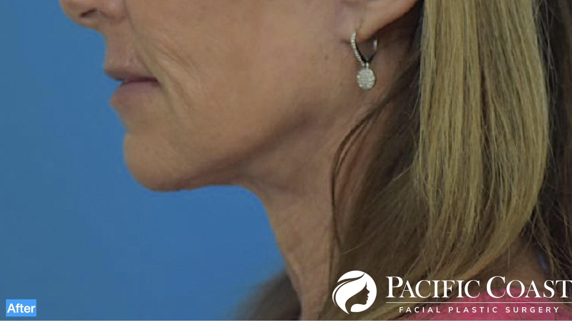 best necklift surgeon in laguna