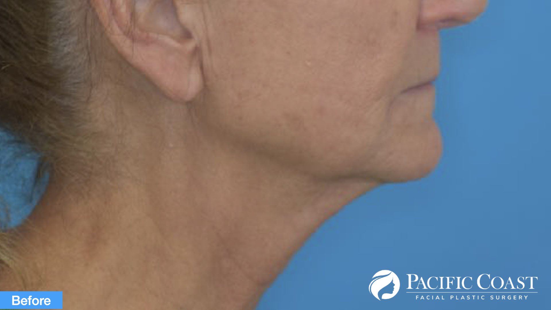 expert facelift surgeon newport beach