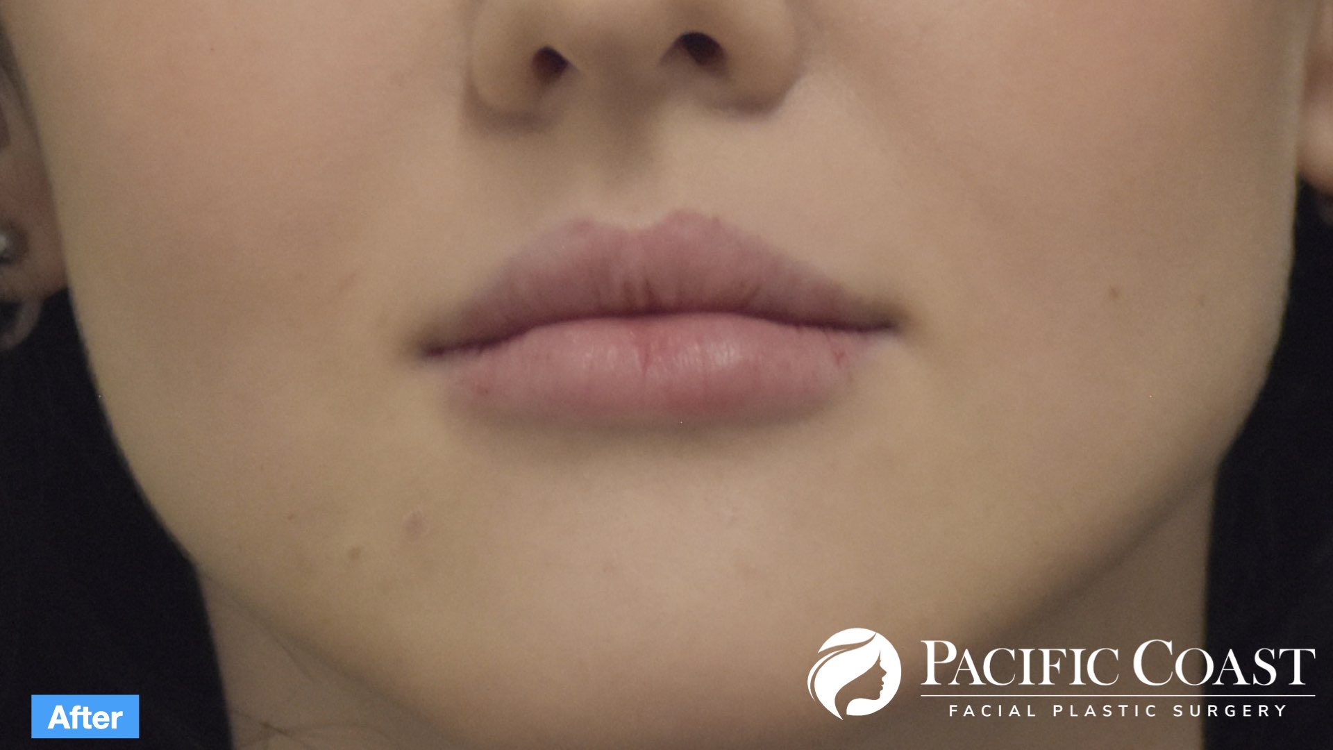 expert lip filler laguna