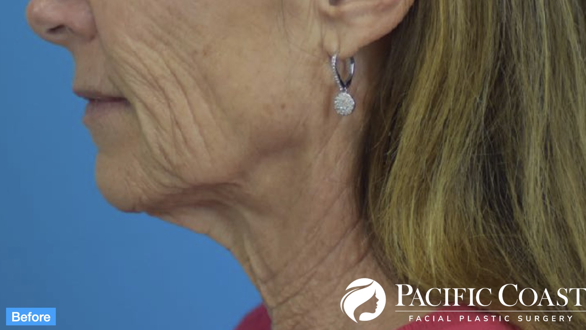 best newport beach facelift surgeon