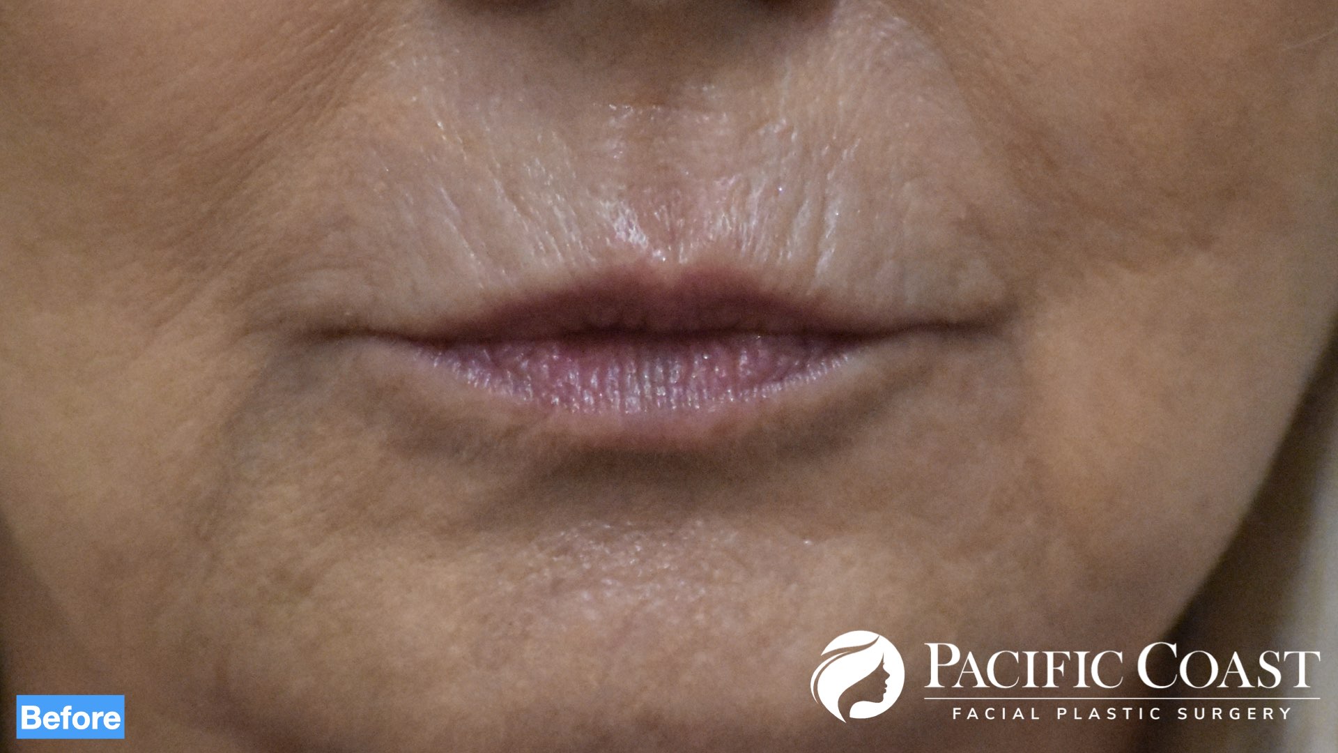 natural lip filler newport beach