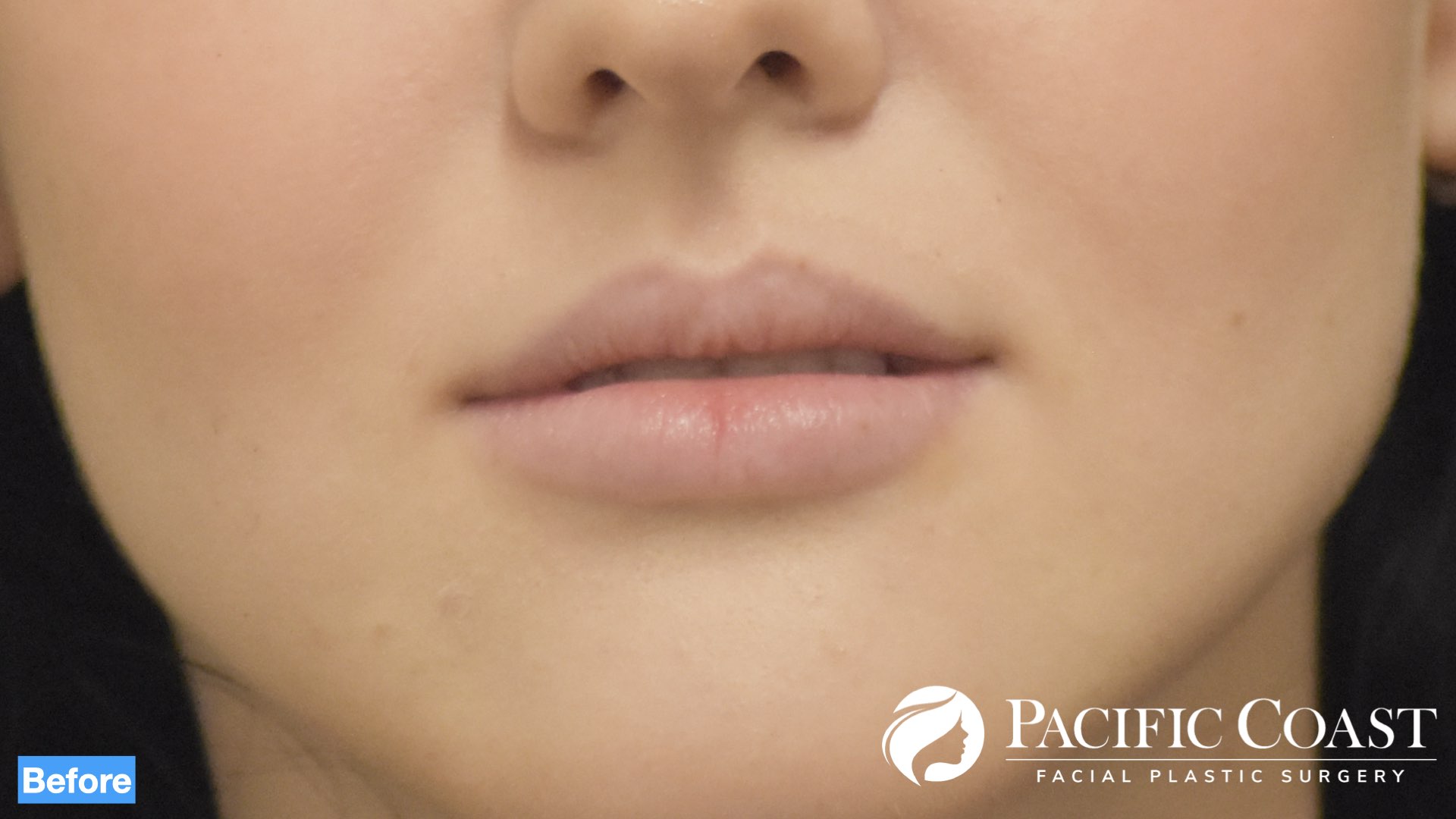 expert lip filler newport beach