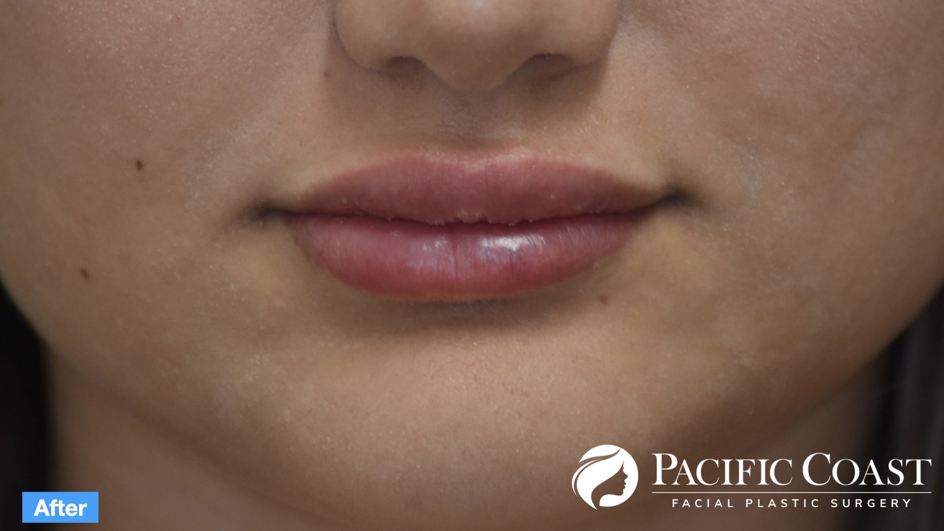 best lip filler laguna