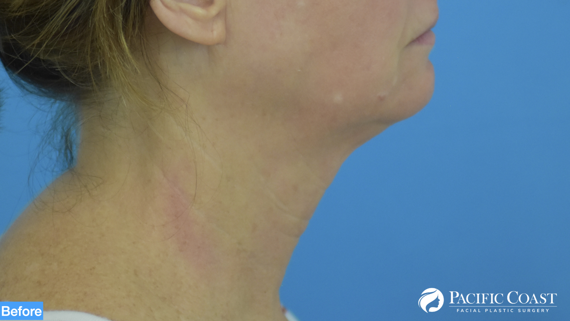 deep plane neck lift orange county