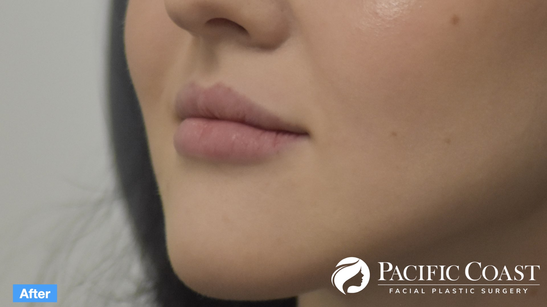 expert lip filler san clemente