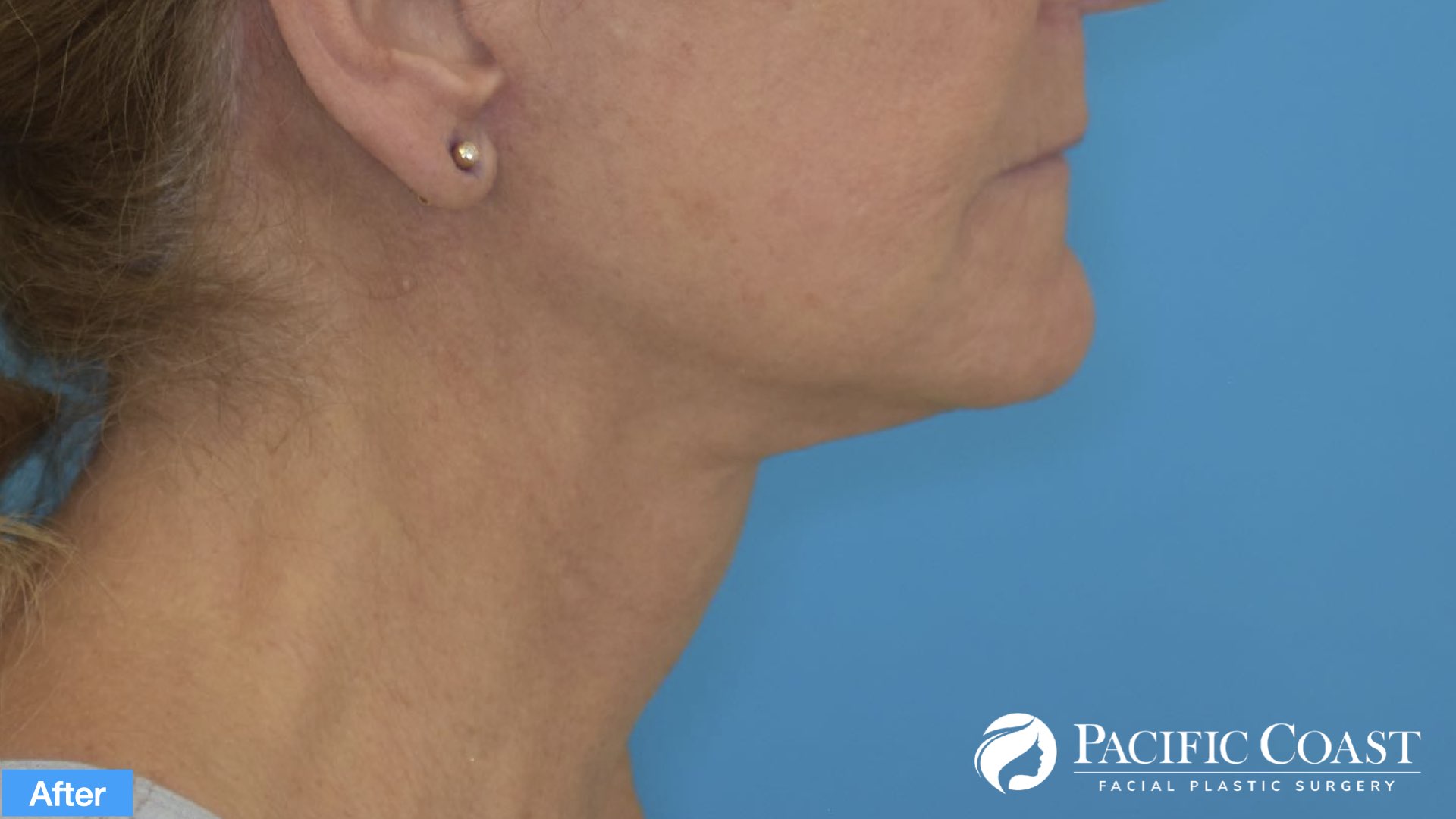 expert neck lift surgeon orange county