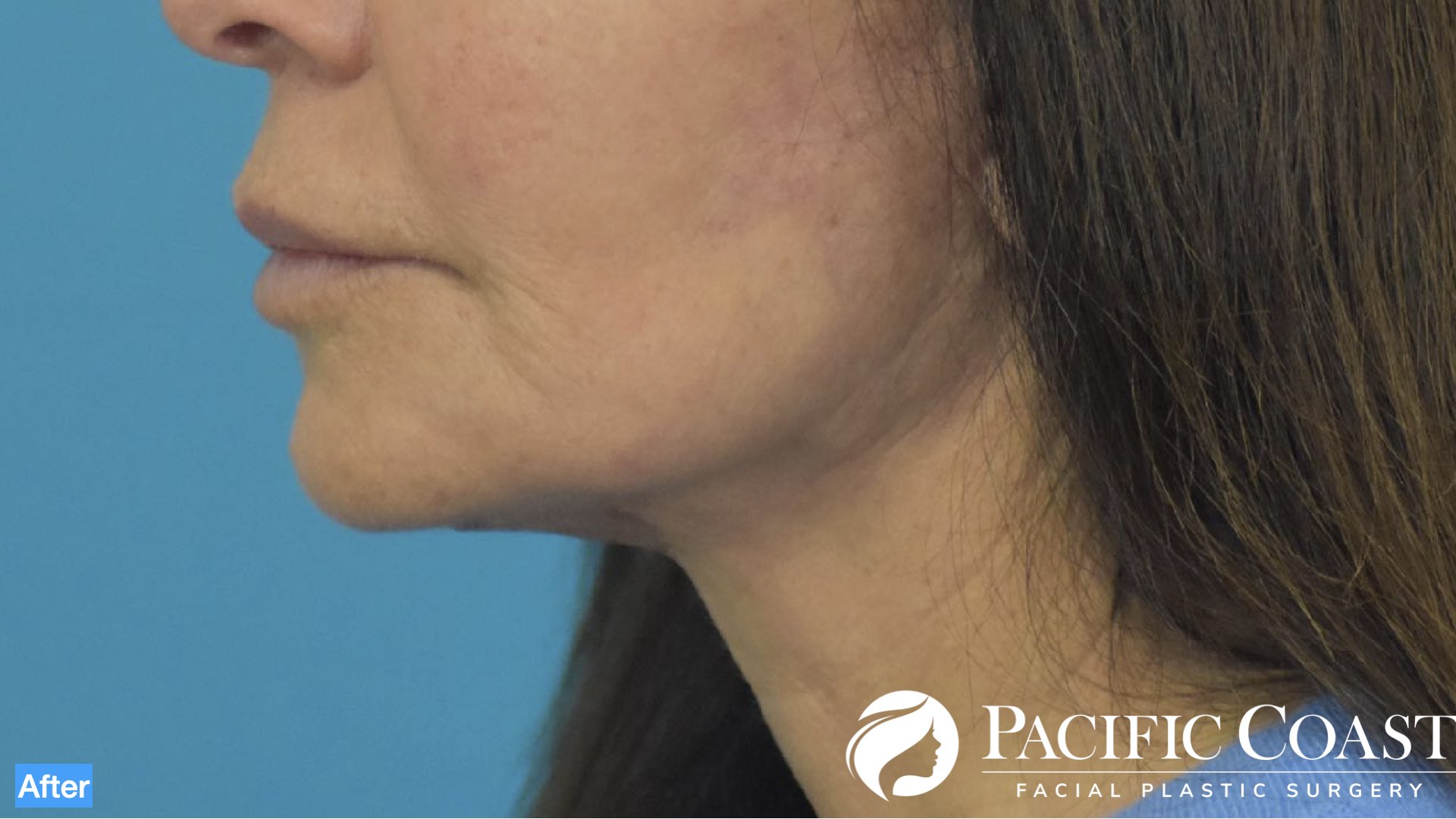 expert deep plane facelift surgeon orange county