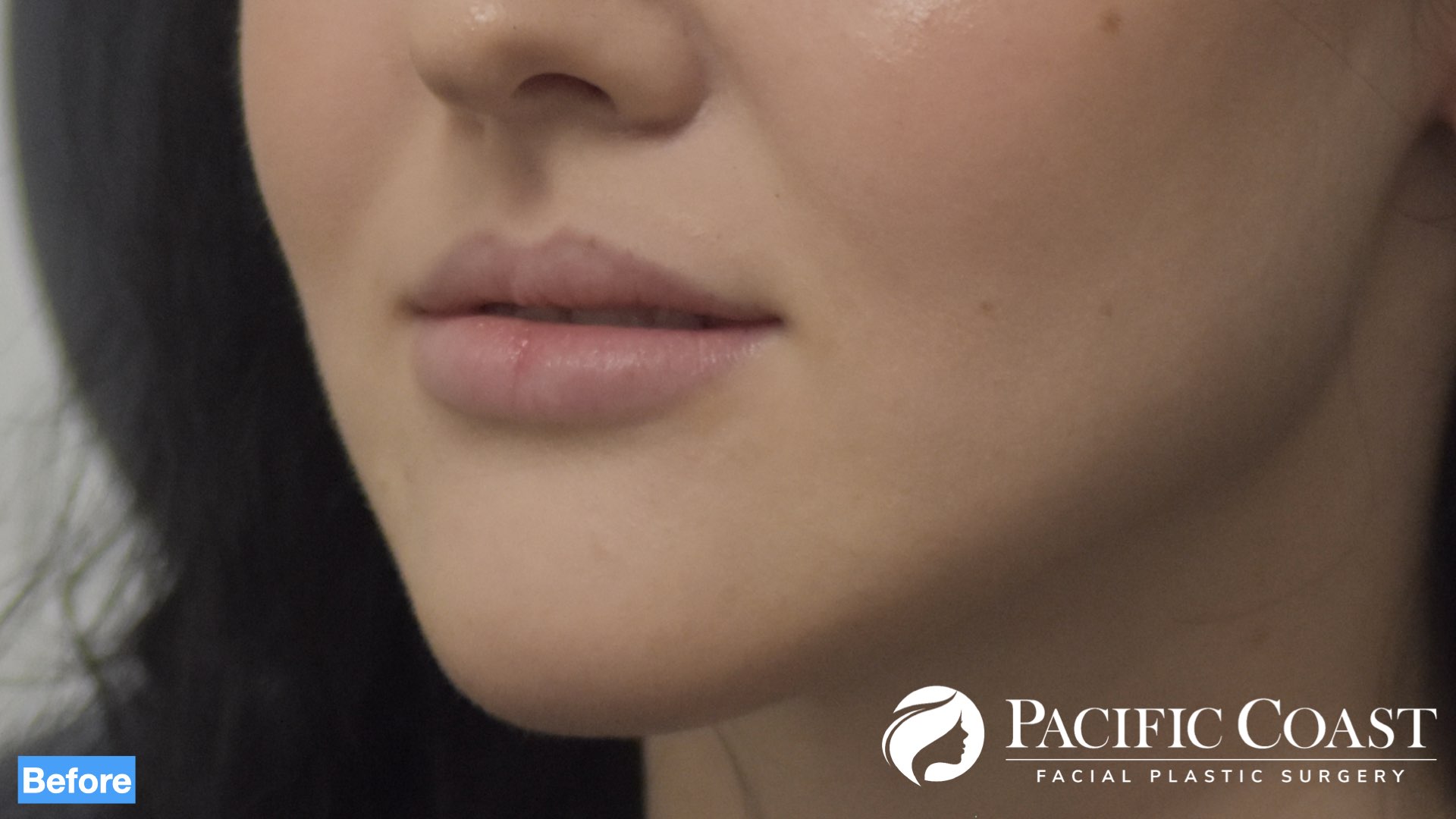 best lip filler orange county