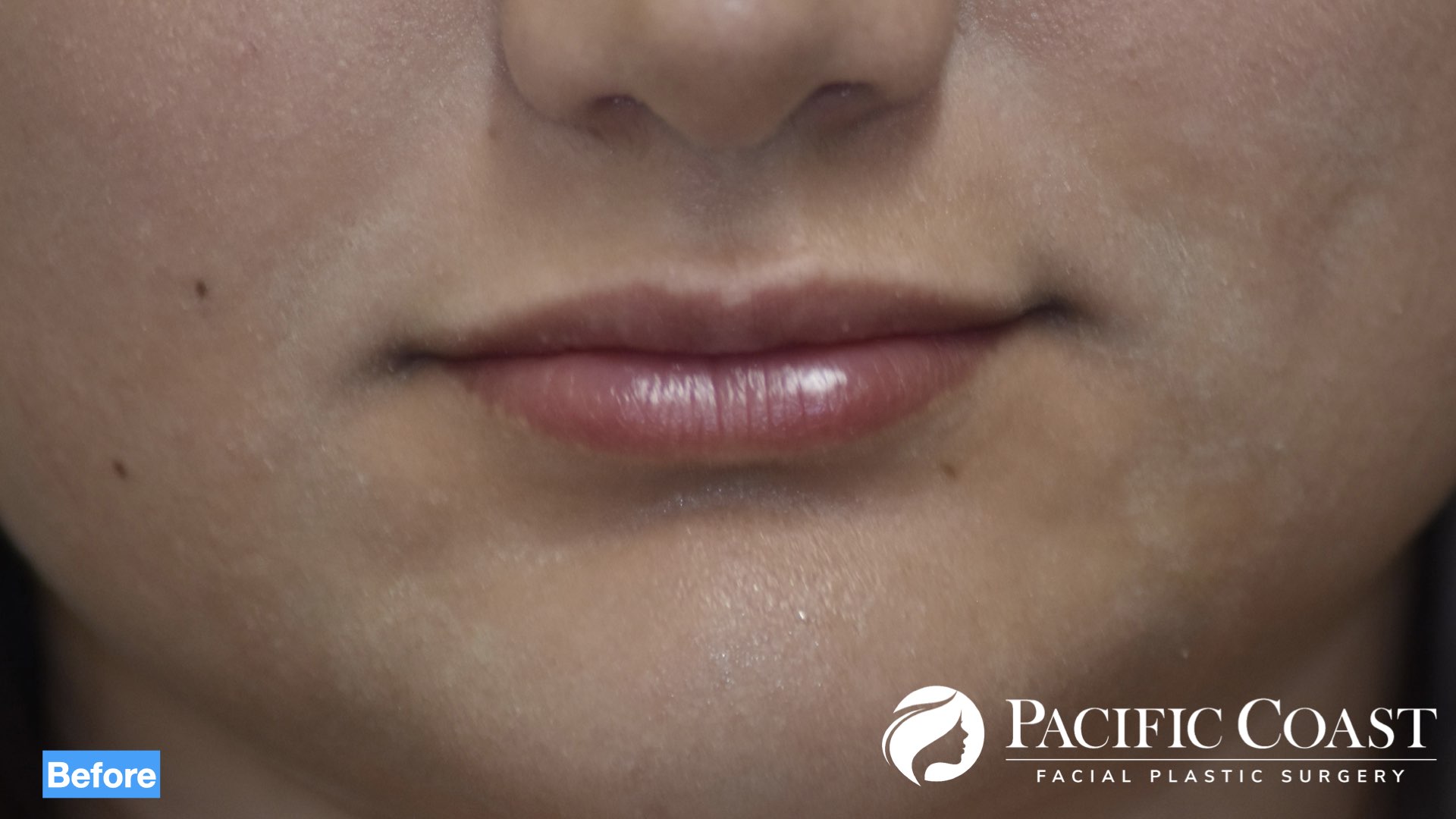 best lip filler in newport beach