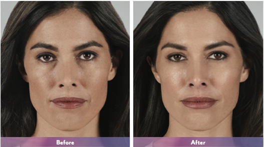 before and after facial plastic surgery