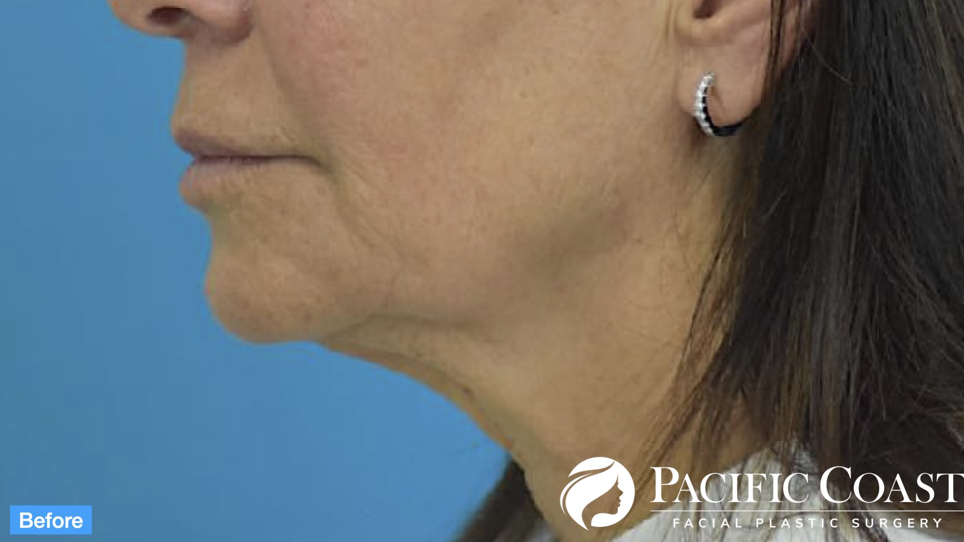 deep plane necklift