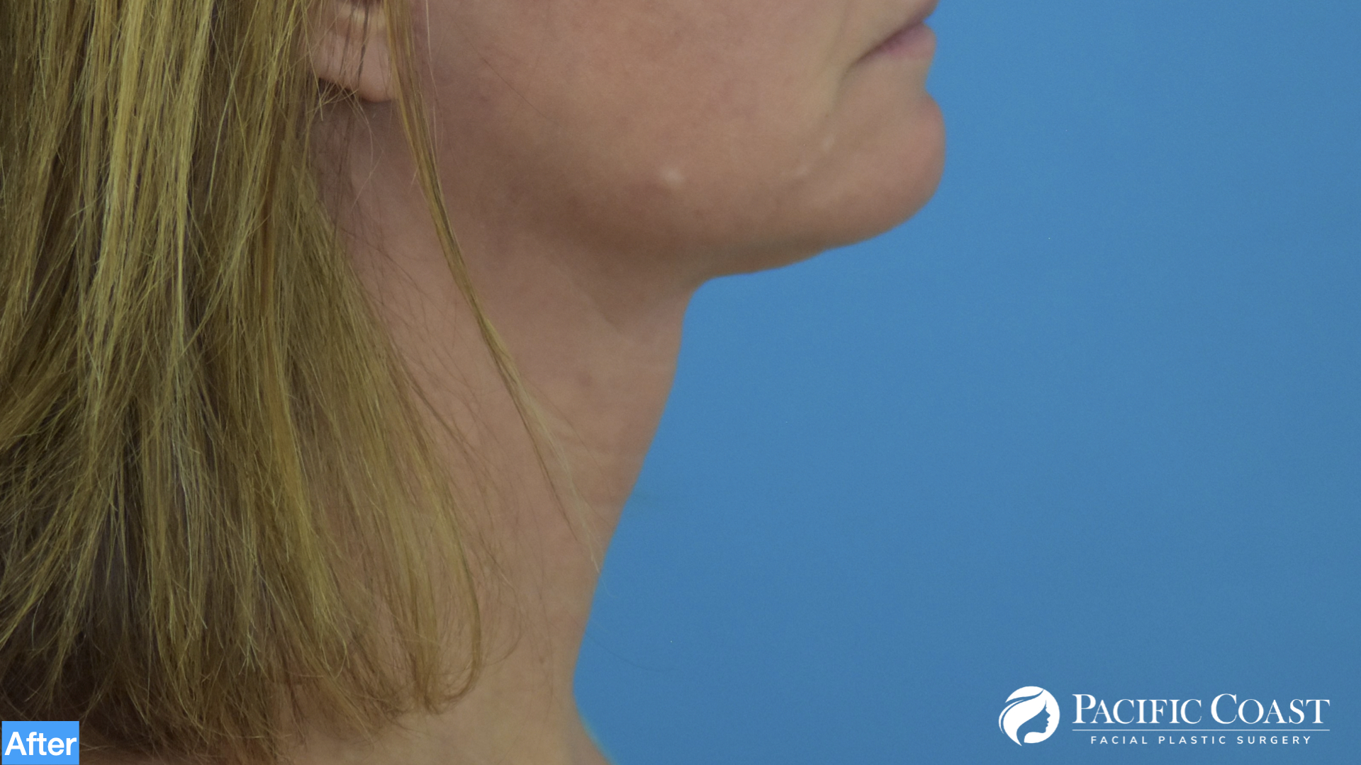 deep plane facelift orange county