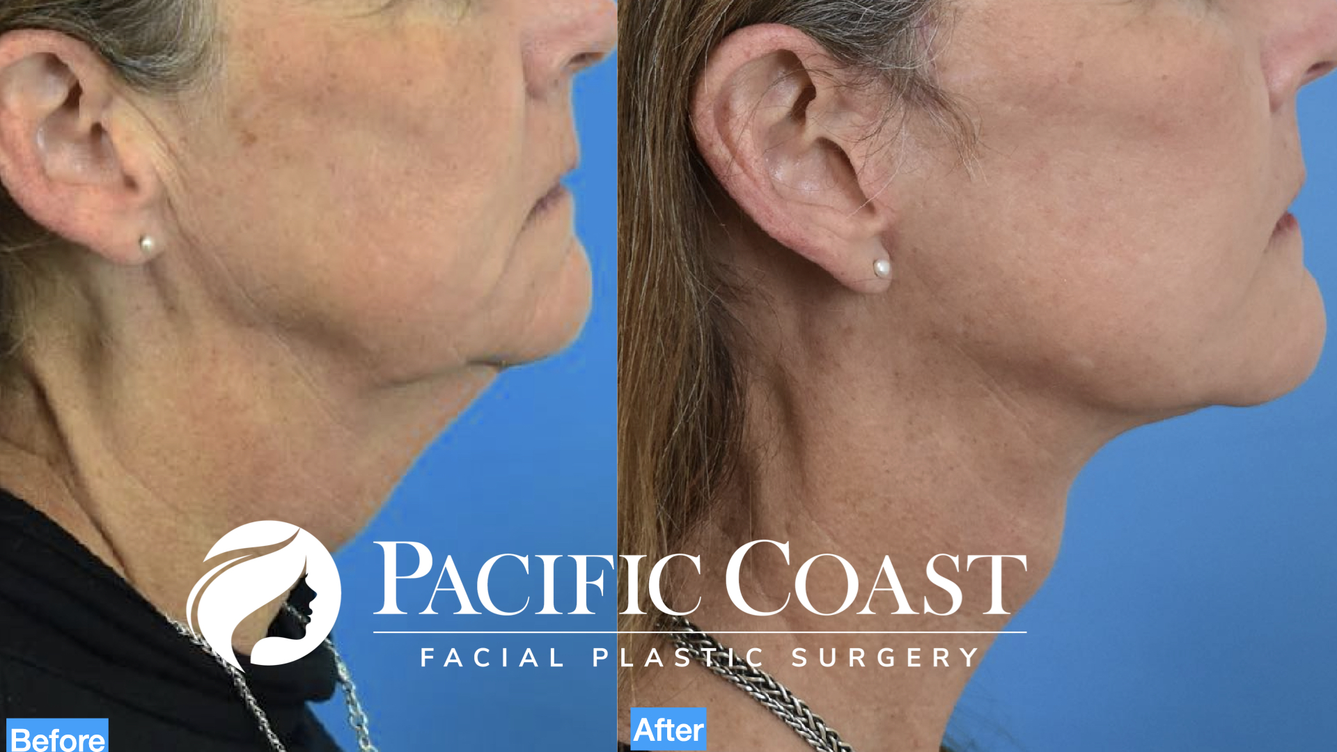 Facelift Before and After  Ranch & Coast Plastic Surgery