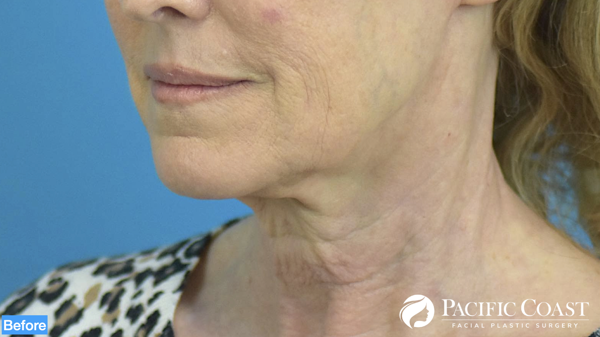 deep plane facelift newport beach