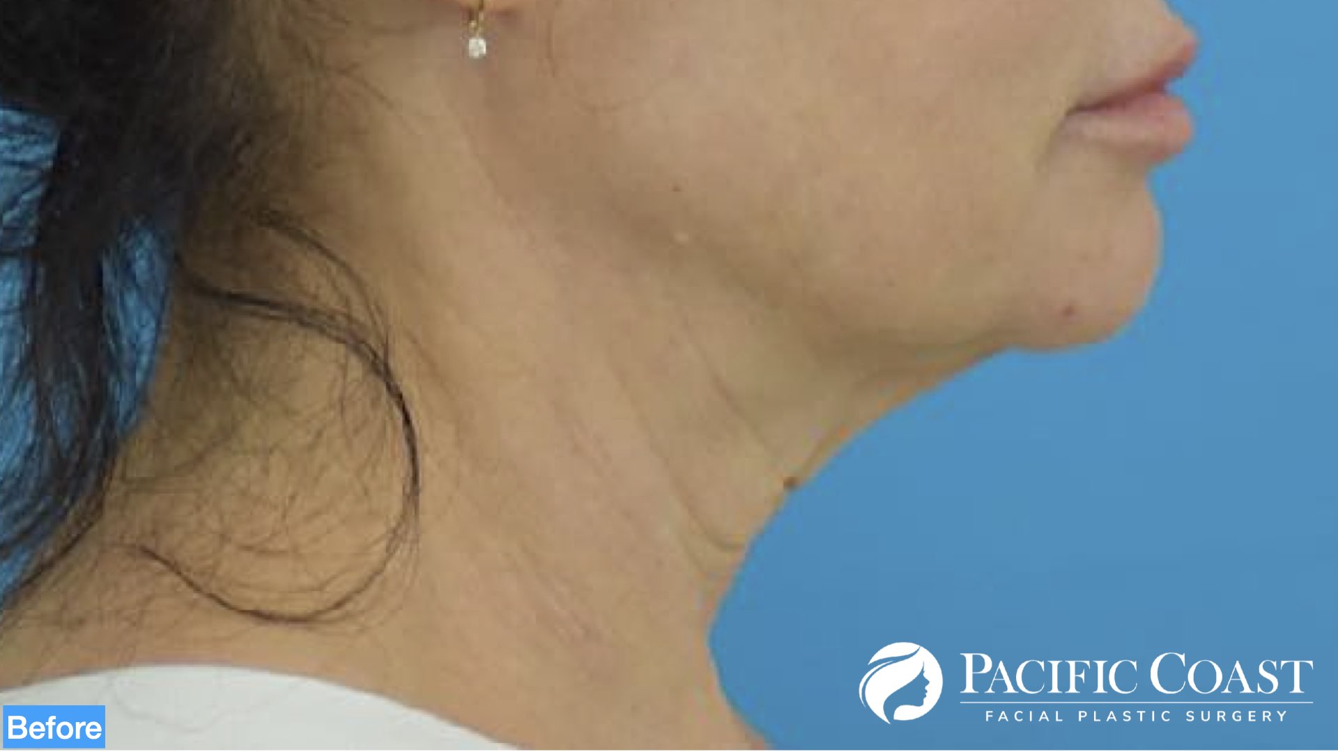 best facelift surgeon newport beach
