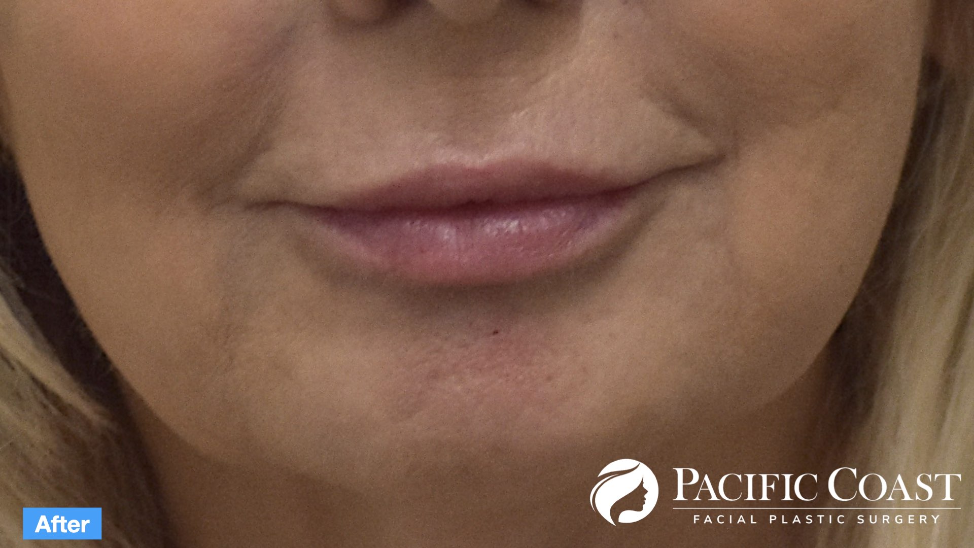 natural lip filler orange county