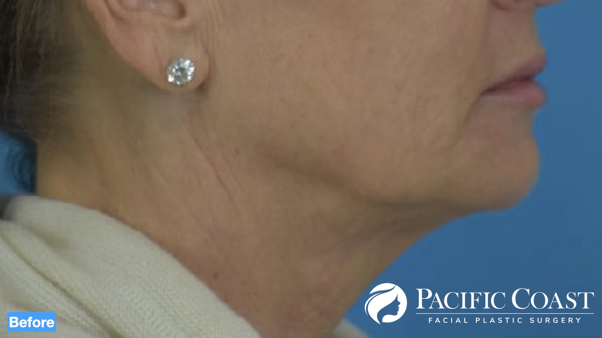 best deep plane facelift surgeon in newport beach