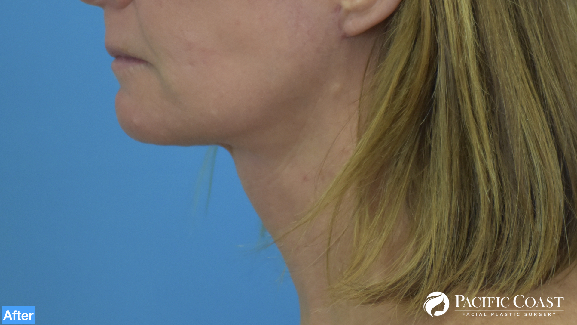 expert neck lift laguna beach