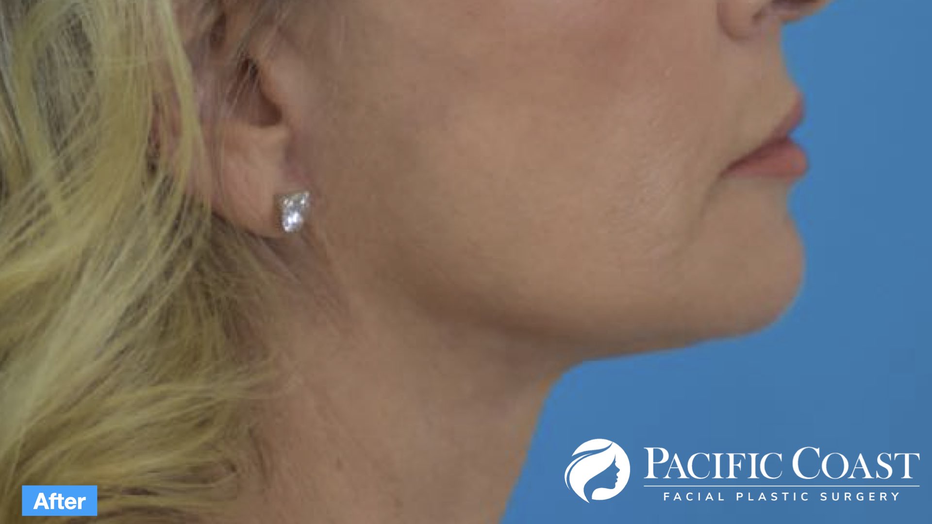 best natural deep plane facelift surgeon orange county