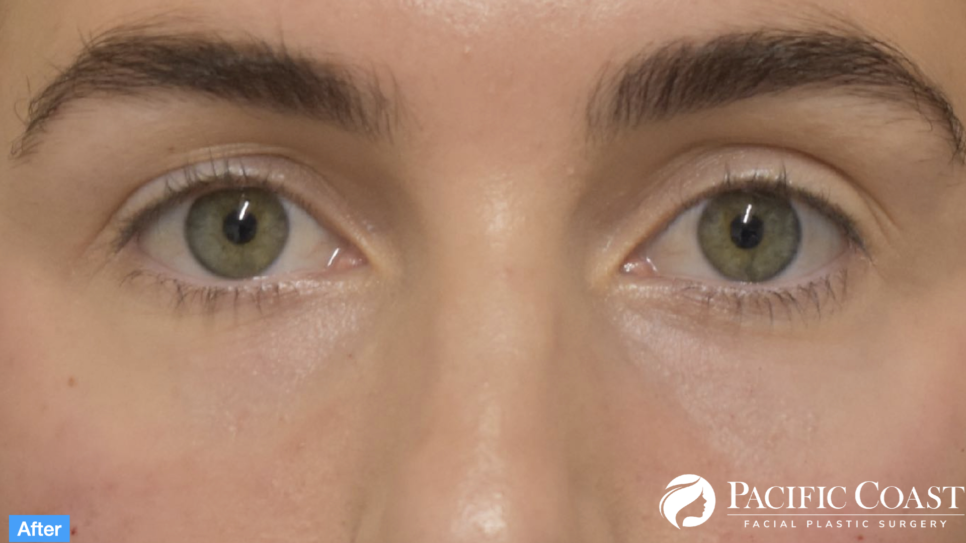 tear trough correction with filler