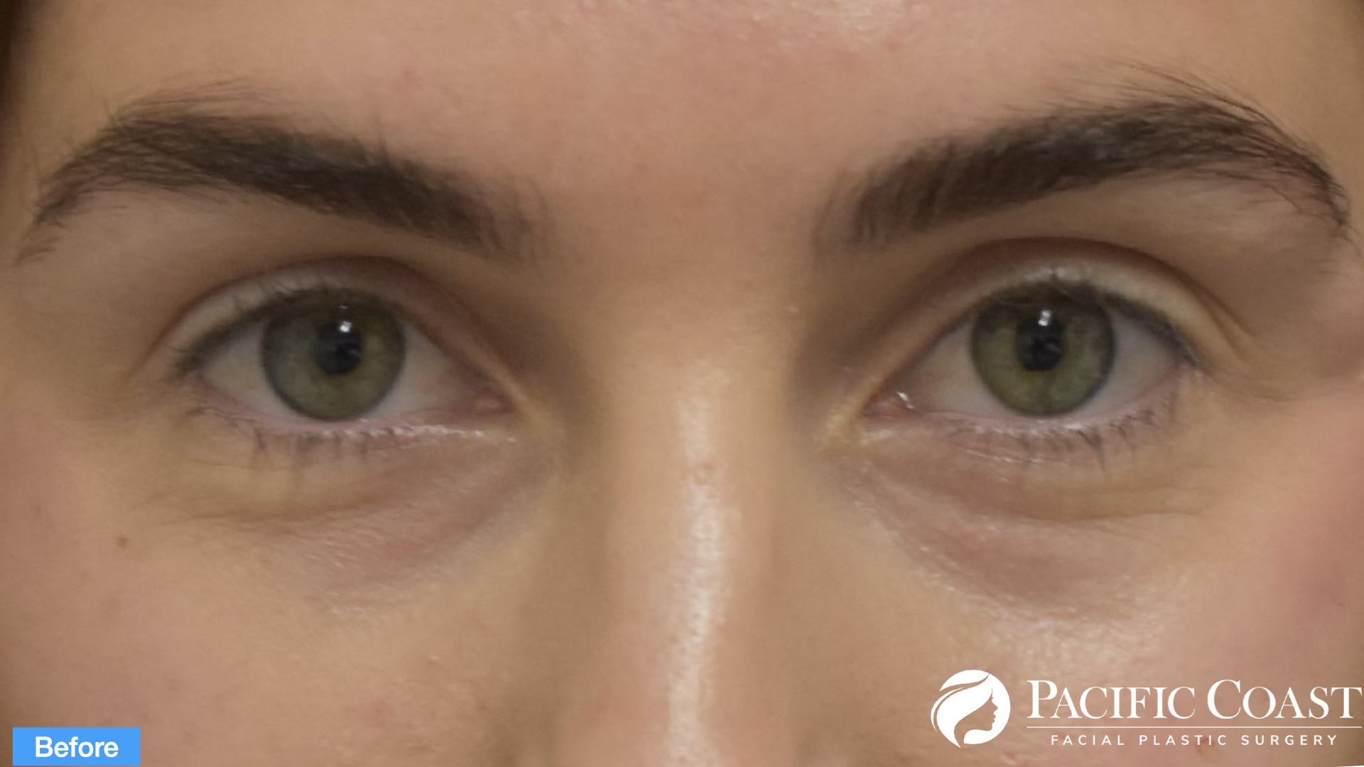 tear trough correction with under eye filler